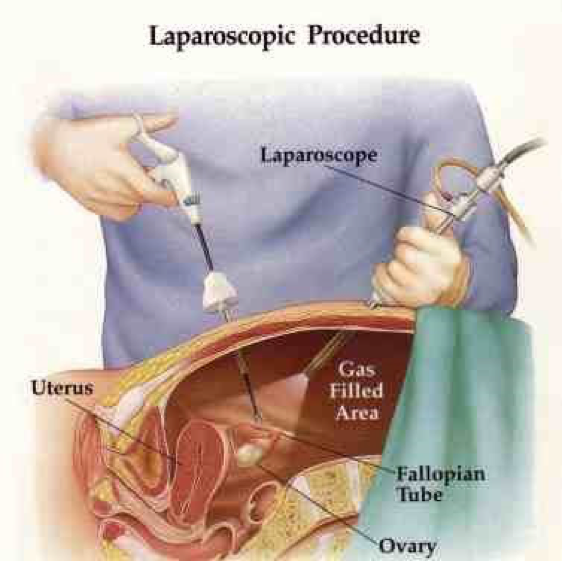 laparoskopi.png